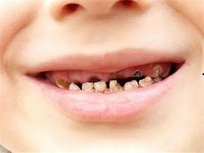 成人蛀牙虫的视频,视频解析口腔健康危机