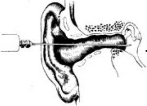 成人鼓膜置管手术视频,全程操作与术后护理详解